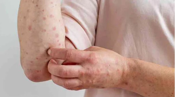 Viruela del mono: ya hay 22 casos confirmados en Argentina Viruela del mono: ya hay 22 casos confirmados en Argentina